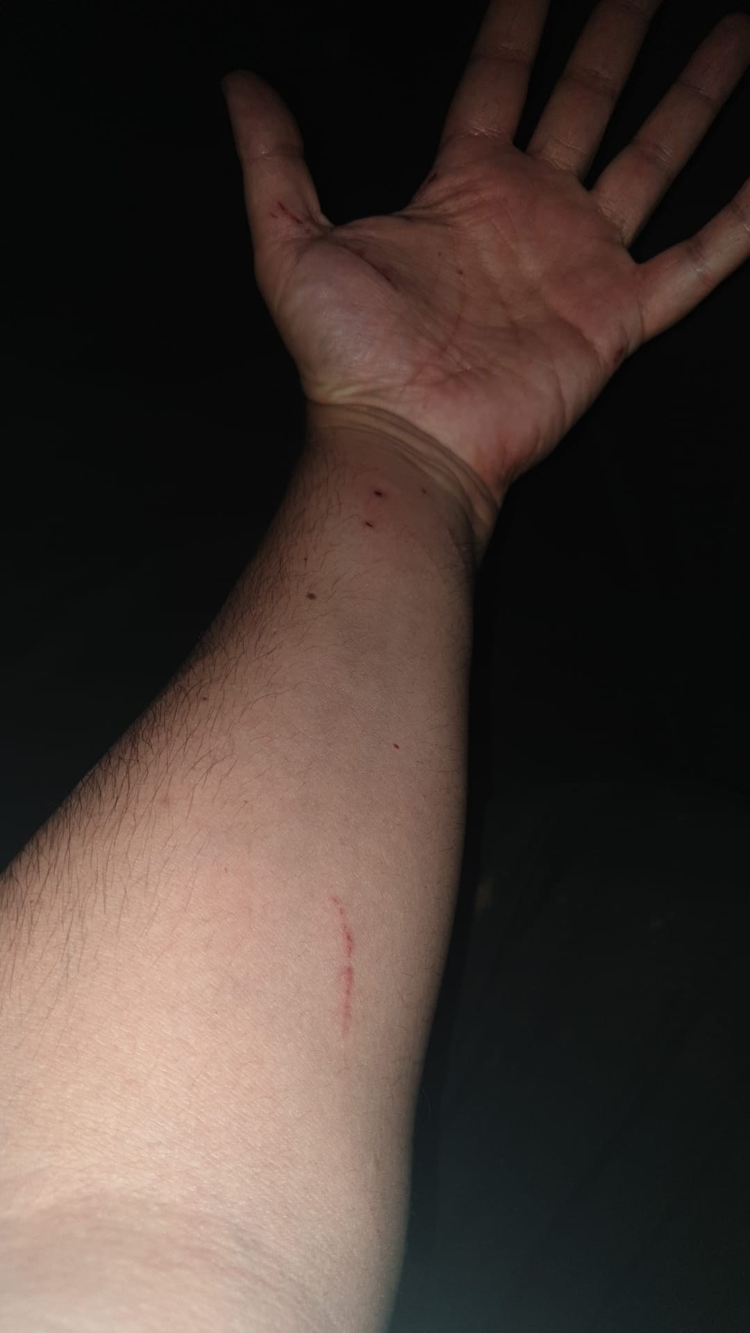 Antebrazo y palma de la mano con varios arañazos superficiales y punciones pequeñas tras el forcejeo con el gato