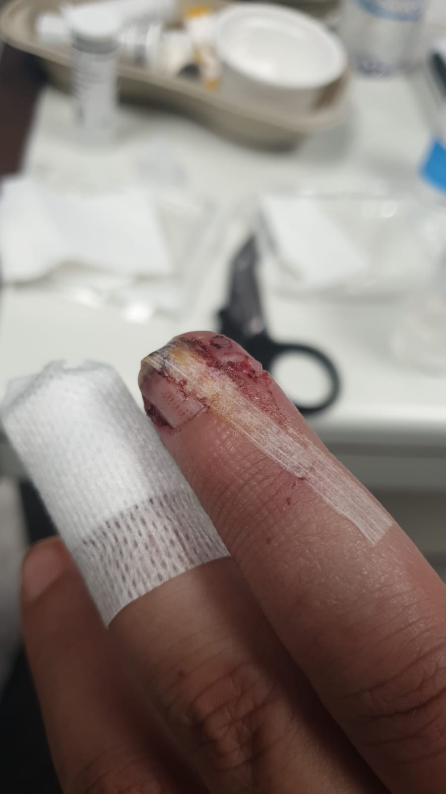 Dedo anular con la uña partida y la yema ensangrentada, antes de la cura, sobre la camilla de la clínica