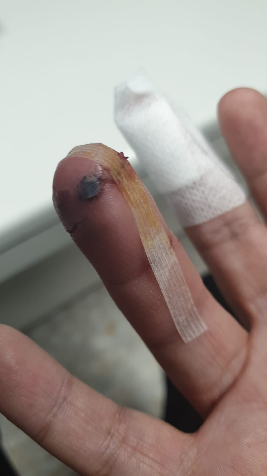 Yema del dedo anular con un hematoma oscuro y las punciones profundas dejadas por los colmillos del gato