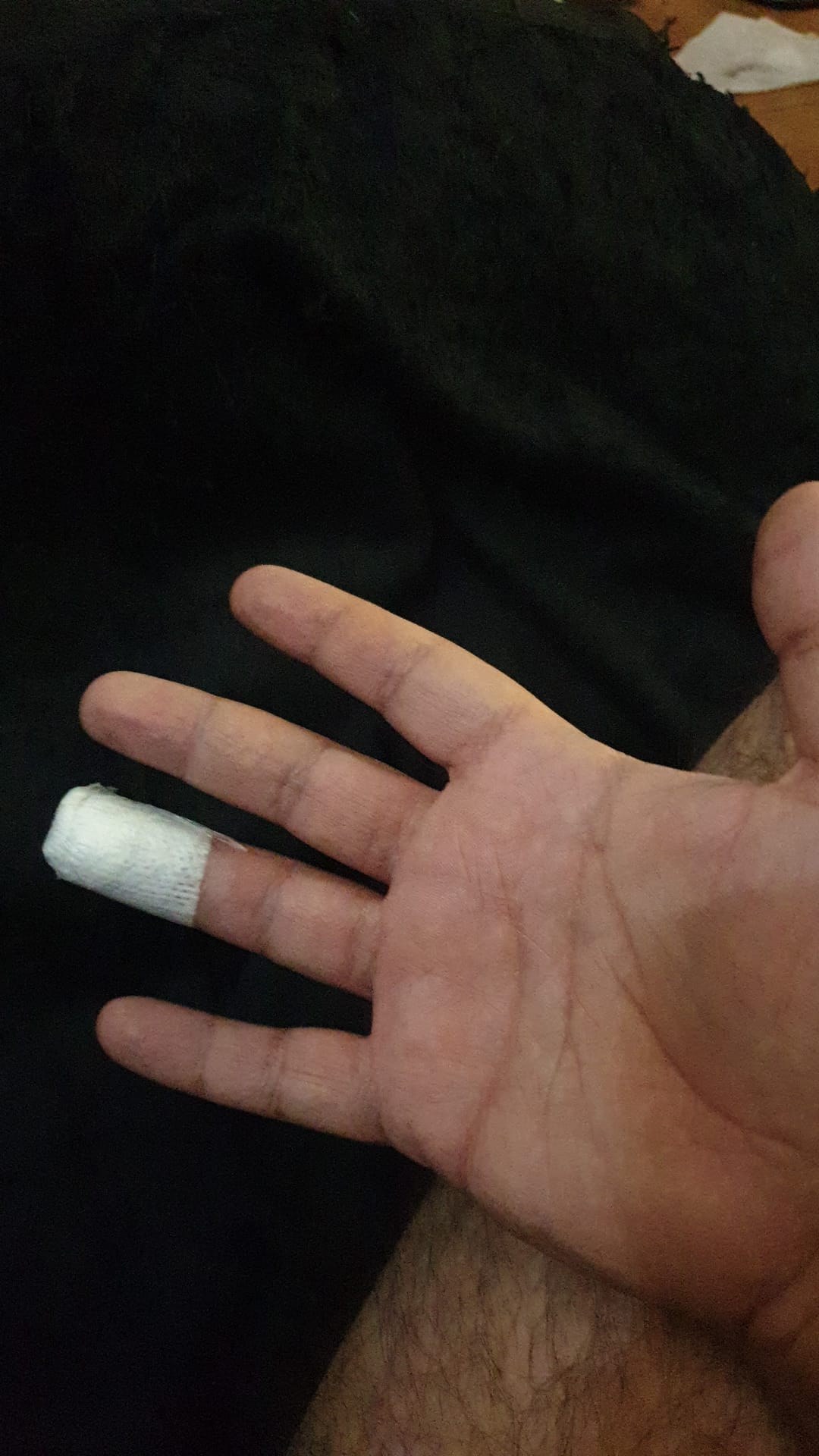 Mano con un solo dedo vendado unos días después, ya con mejor aspecto
